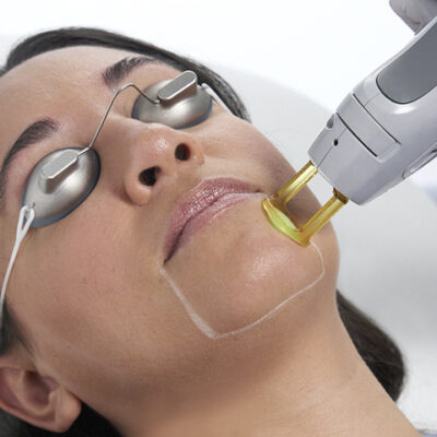 Blog_Image_what-its-like-to-get-laser-hair-removal-on-your-face_FNL