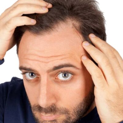 Can-dandruff-cause-hair-loss2