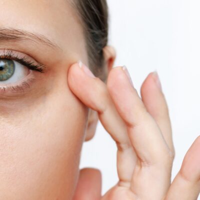 A,Young,Caucasian,Woman,Demonstrating,Dark,Circles,Under,Her,Eyes