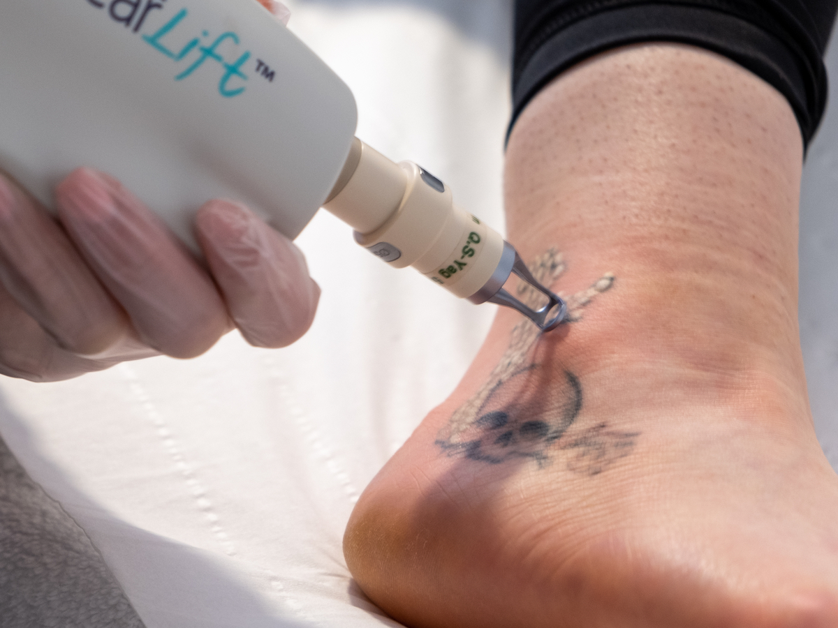 Tattoo-removal