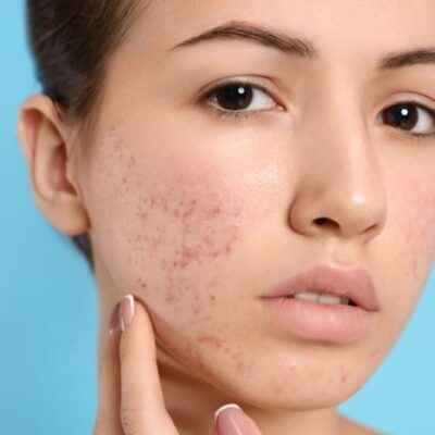 Treatment-for-Acne-Scars-in-Oakbrook-Terrace-1-1024x678
