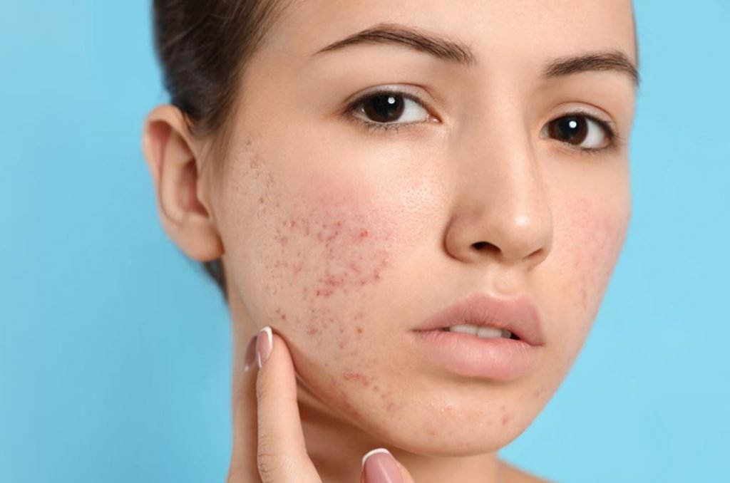 Treatment-for-Acne-Scars-in-Oakbrook-Terrace-1-1024x678