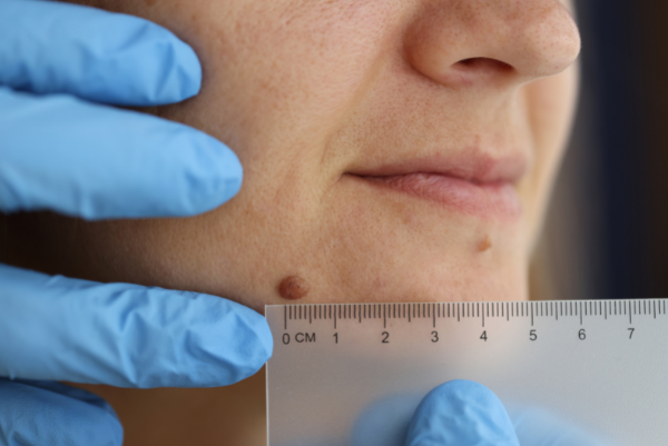 Wart-Removal-Treatment_Mayra